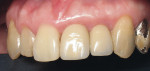 Figure 15  Clinical view of crowns in place for 2 years. Crevicular depth around implant crowns is 2 mm without bleeding on probing. No recession has occurred during the 2-year restorative phase.