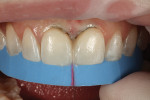 With the midline and proximal contact established, the Mylar strip is left in place, and the final layer of single-shade universal composite is layered onto the mesiofacial aspect.
