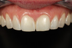 The 6-month postoperative follow-up photograph demonstrates marginal integrity, color stability, and polish that look as good as the day the restoration was completed.