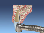 Fig 1. Preparation of the osteotomy by scoring the palatal wall of the socket with a bur or osteotome.