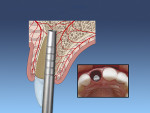 Fig 4. Osteotome scoring the palatal wall. Osteotomy positioned for a screw-retained prosthesis.