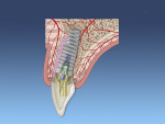 Fig 3. Placement of implant with a cement-retained restoration.