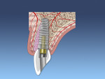 Fig 5. Implant placement with a screw-retained restoration.