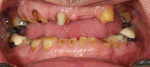 Fig 1. The patient presents with severely worn dentition, as shown prior the start of treatment.