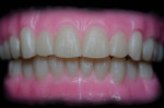 Fig 4. An implant-retained wax try-in is created after the second clinical appointment.