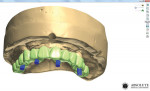 Fig 10. The final tooth overlay is designed to fit the substructure perfectly