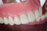 Fig 1. Both the teeth and the base were milled from Dentsply Sirona materials using an Avadent design.
