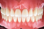 Fig 4. Bonded Candulor teeth are set in a milled Avadent base, according to an Avadent design.