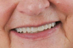 Fig 8. The patient is happy with her digitally produced dentures upon delivery.