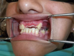 Fig 1. The framework try-in shows how well the pink clasps blend in with the gingiva.