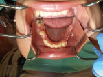 Fig 4. The mandibular framework try-in is evaluated for fit and esthetics.