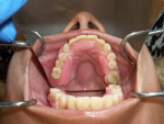 Fig 6. The try-in with the teeth set in wax.