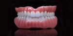 Available exclusively from Custom Milling Center, the Zirlux Superior Digital Denture is a highly esthetic and customizable monolithic milled denture that eliminates the need for bonded or glued-in teeth. This digital denture is available in three tissue shades, is FDA-cleared for long-term use, and offers 100-MPa strength. This highly esthetic solution contains a pink tissue application that mimics natural gingiva contours and vitality.
