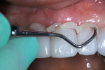 Figure 9  A scaler was used to remove the excess cement from the interproximal and buccal areas of the crowns.