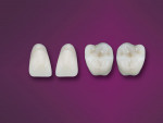 Kulzer's PALA teeth
