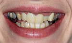 Figure 2  Midline, cant, tooth proportion, and other smile deficiencies were noted, along with the ideal soft-tissue desires.