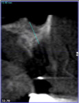 Fig 4. CBCT scan showed apical native bone available to stabilize implant and allograft ring.