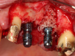 Fig 6. Implant placement; the apical threads further stabilized the allograft ring.