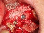 Fig 8. Particulate xenograft placed on buccal aspect of the site.