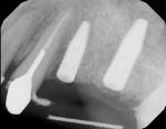 Fig 10. Periapical radiograph depicting osseointegrated implants after 6 months of hard-tissue maturation.