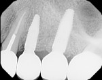 Fig 13. Final periapical radiograph.