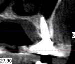Fig 14. Final CBCT depicting osseointegrated implant and complete regeneration of the buccal plate.