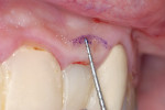 Figure 11  The sulcus depths were transferred to the gingival and marked with an indelible pencil.