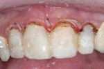 Figure 13  After a composite mock-up, 3 mm of gingival tissue removal satisfied the tissue enhancement goals. This was within the biologic framework.