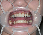 Figure 14  After recontouring soft tissue, the patient was evaluated. A digital photograph was taken and reviewed for symmetrical removal and conformity to facial landmarks.