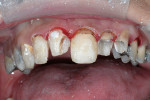 Figure 15  All teeth but a single central incisor were prepared in order to maintain a definitive anterior occlusal stop during bite registration, and to act as a reference during tooth preparation.