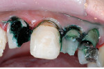 Figure 16  After gross decay removal, a caries indicator was used to verify complete damaged dentin removal.