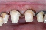 Figure 19  The teeth were prepared with rounded shoulders 0.5 mm to 1 mm into the recontoured sulcus. A retraction/hemostatic putty was placed and rinsed after 5 minutes.