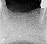 A presurgical radiograph of the patient’s mandibular anterior alveolus exhibits extensive loss of bone height.