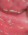 A presurgical photograph of a portion of the patient’s mandibular anterior alveolus highlights the contrast in bone width between the edentulous ridge segment and the immediately adjacent dentate region.