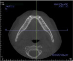 A CT scan view of the patient’s mandibular anterior alveolus reveals correspondingly substantial loss of bone width.