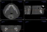 CT scan imagery is used to generate the STL files needed for the CAD/CAM process to fabricate a surgical stent to guide implant placement.