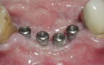 The four healing abutments in place immediately after implant uncovering.