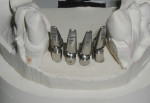 The four custom abutments on the laboratory model.