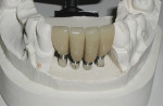 The four PFM crowns seated on the custom abutments.