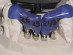 The two laboratory fabricated insertion jigs. Supported by the adjacent teeth, the jigs situate the abutments accurately onto the individual implants.