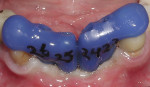 The insertion jigs with the abutments inside them positioned on the implants.