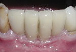 At a 1-week recall appointment, minimal to no inflammation is observed despite less than ideal oral hygiene.