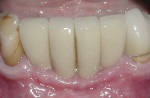 At 6 months, even more gingival refinement can be observed.