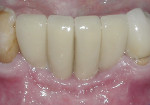 After 1 year, the gingival architecture has fully matured and been maintained.