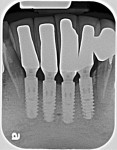 A 1-year follow-up radiograph demonstrates bone levels between the adjacent implants that are well above their first threads, approaching their shoulders.