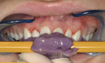 Figure 8  Comparison of the gingival positions relative to the horizontal stick reference.