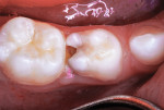 Distal caries lesion of mandibular right primary first molar.