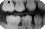 Radiograph showing extent of the caries lesion.