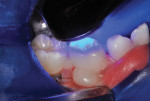 Zirconia crown seated, and curing light applied.