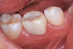 Postoperative occlusobuccal view of crown after 46 months.